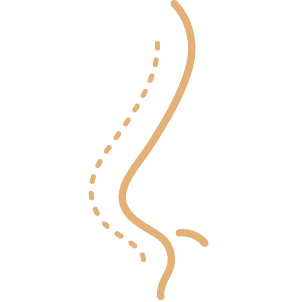 Rinoplastia
