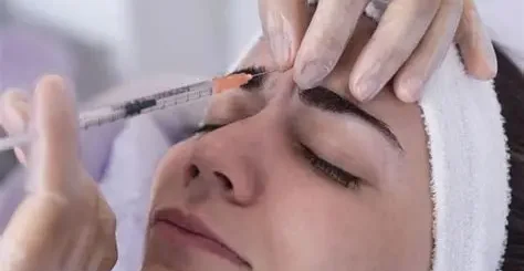 toxina botulínica entrecejo imagen